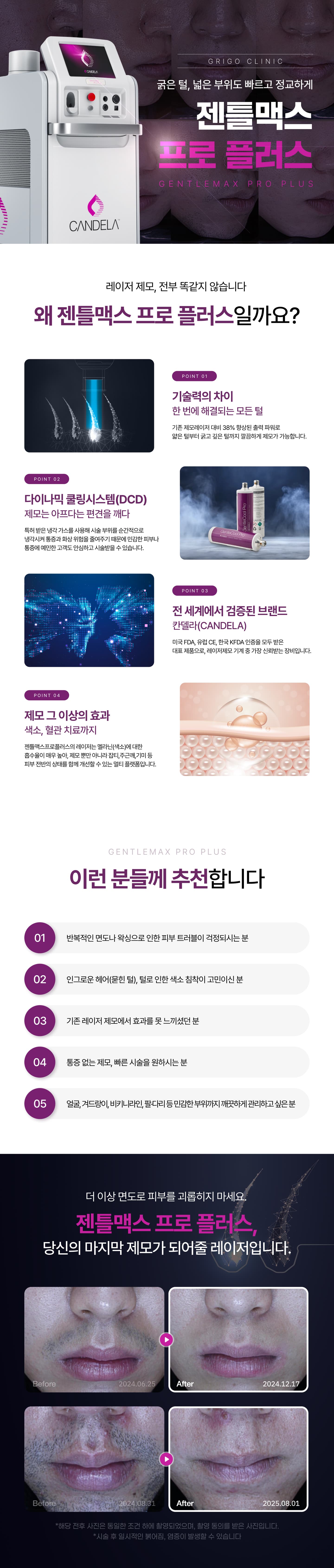 [젠틀맥스프로플러스] 남성제모
